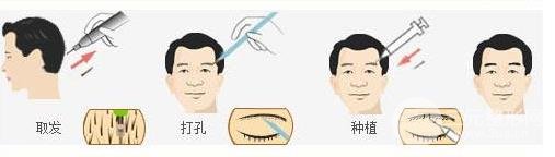 植眉毛价格大揭秘，自信的力量与价格变化解析